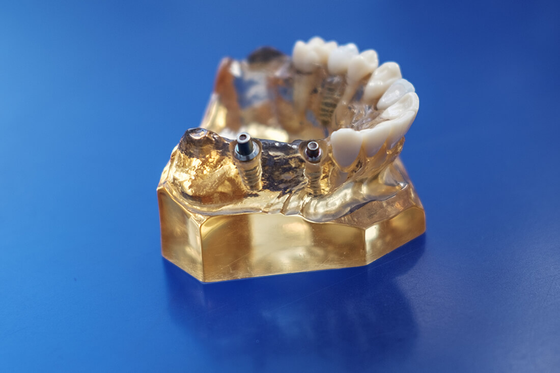 Mund-, Kiefer- und Gesichtschirurgie Hannover – Bothe – Zahnimplantate Mund-, Kiefer- und Gesichtschirurgie Hannover - Bothe - Zahnimplantate